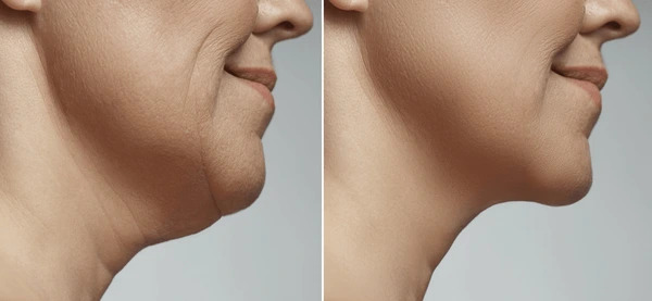 Giảm cân sẽ giúp bạn có đường viền hàm rõ nét hơn