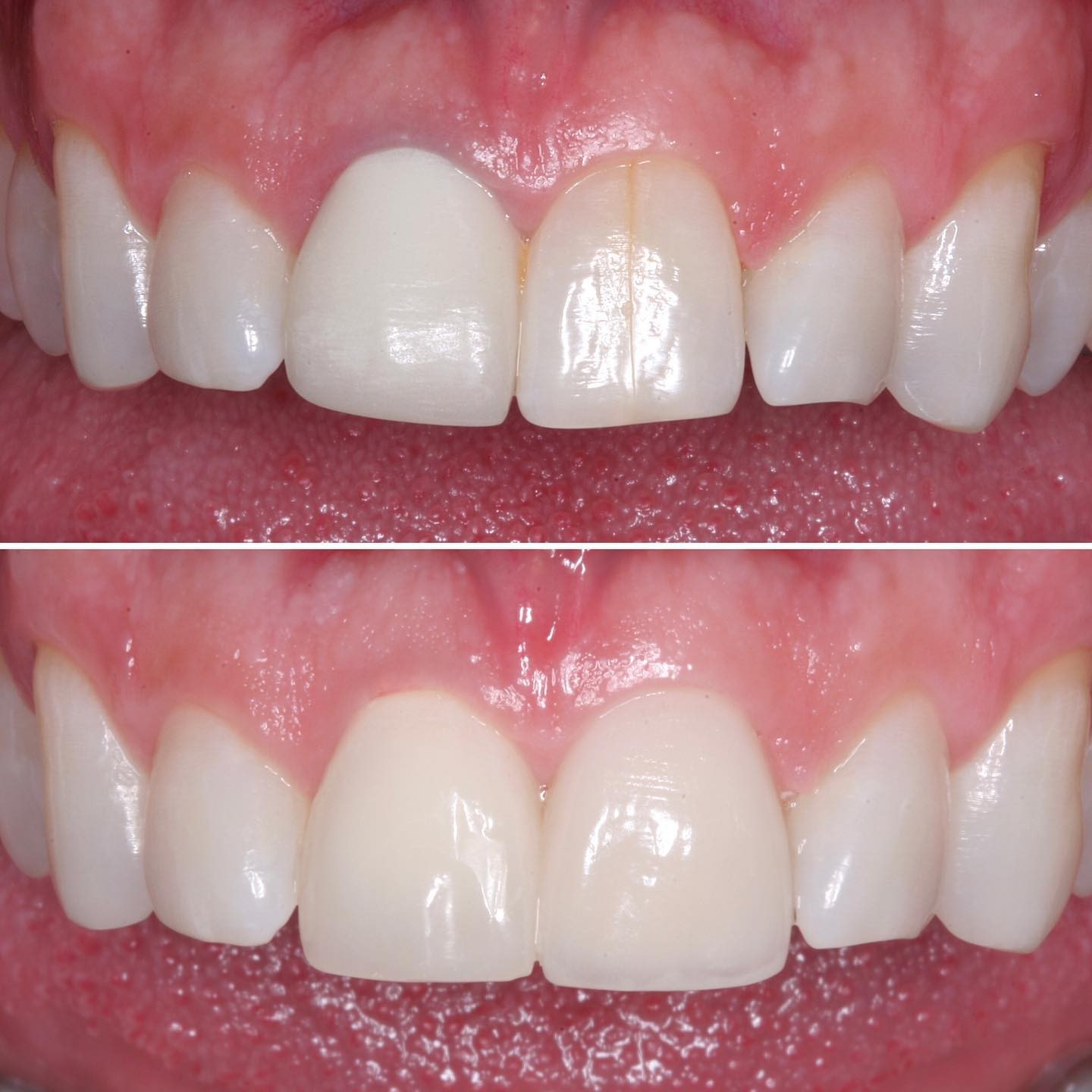 Hình ảnh trước và sau khi điều trị các đường rạn men