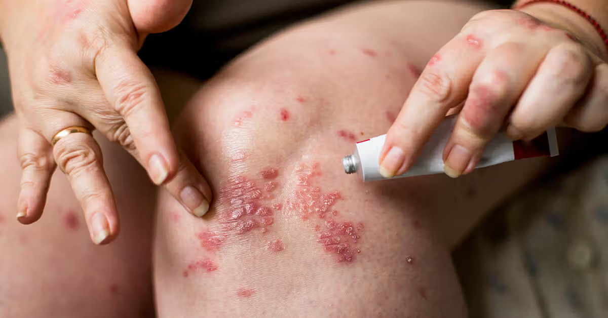 Lạm dụng thuốc bôi corticoid có thể làm gia tăng nguy cơ gặp tác dụng phụ nghiêm trọng