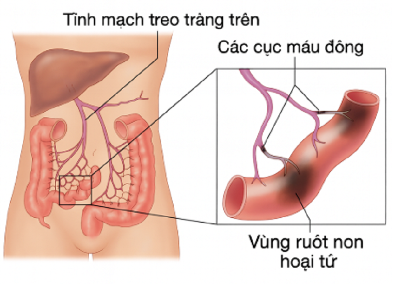 Phình tách động mạch mạc treo tràng trên cần được điều trị kịp thời - Ảnh: medlatec.vn