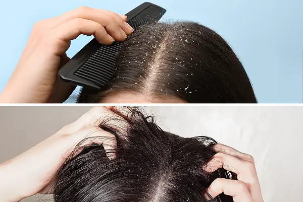 Thói quen cào gãi da đầu bằng móng tay hoặc đồ vật sắc có thể khiến gàu nặng hơn