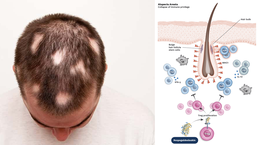 Cơ chế kích thích mọc tóc của Rezpeg (rezpegaldesleukin)