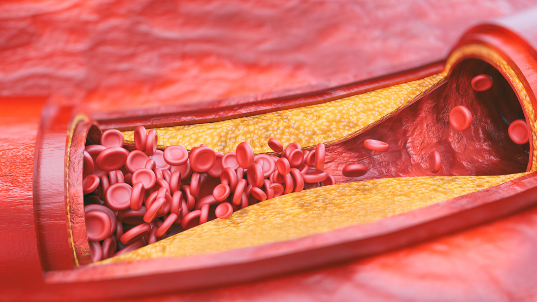 Mảng bám tích tụ trong động mạch khi cholesterol và triglyceride tăng cao