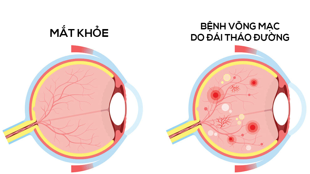 Các mạch máu bị tổn thương do biến chứng đái tháo đường có thể dẫn đến mù lòa