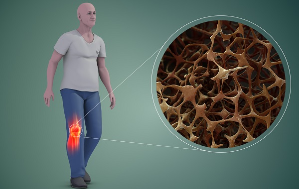 Không ít các trường hợp chỉ được phát hiện bệnh khi đã có gãy xương