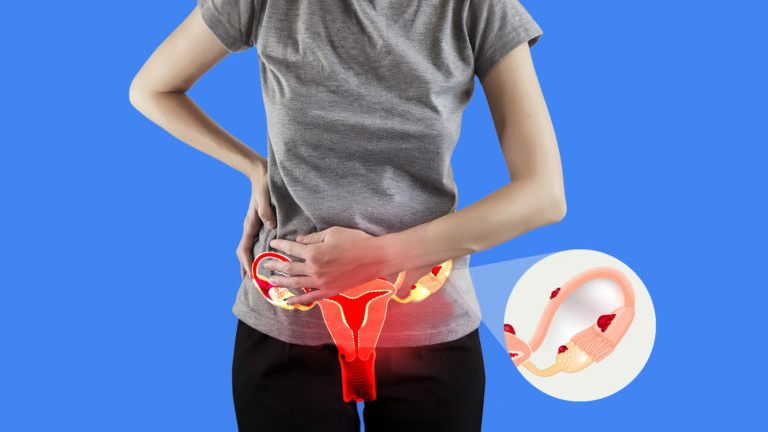 Các mô nội mạc tử cung đi lạc gây đau bụng kinh dữ dội ở phụ nữ
