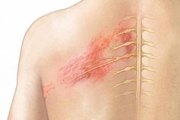 Đáng chú ý, rủi ro này ở người từng mắc zona có thể kéo dài đến 10 năm sau khi khỏi bệnh.