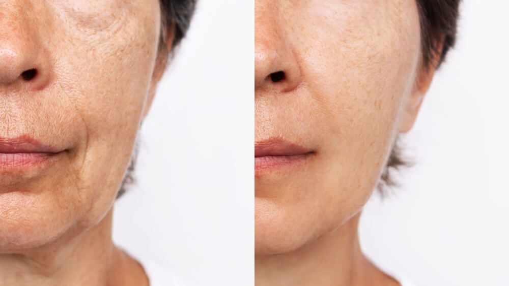 Da xỉn màu, chảy xệ và xuất hiện nếp nhăn sớm là những biểu hiện thường gặp của lão hóa do đường