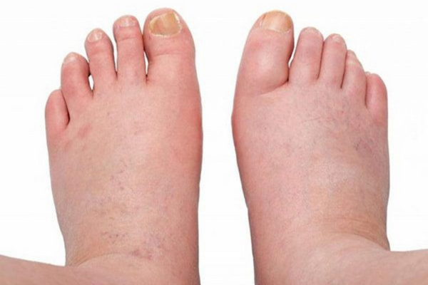 Biến chứng làm sưng tấy, phù nề chân do bệnh gan