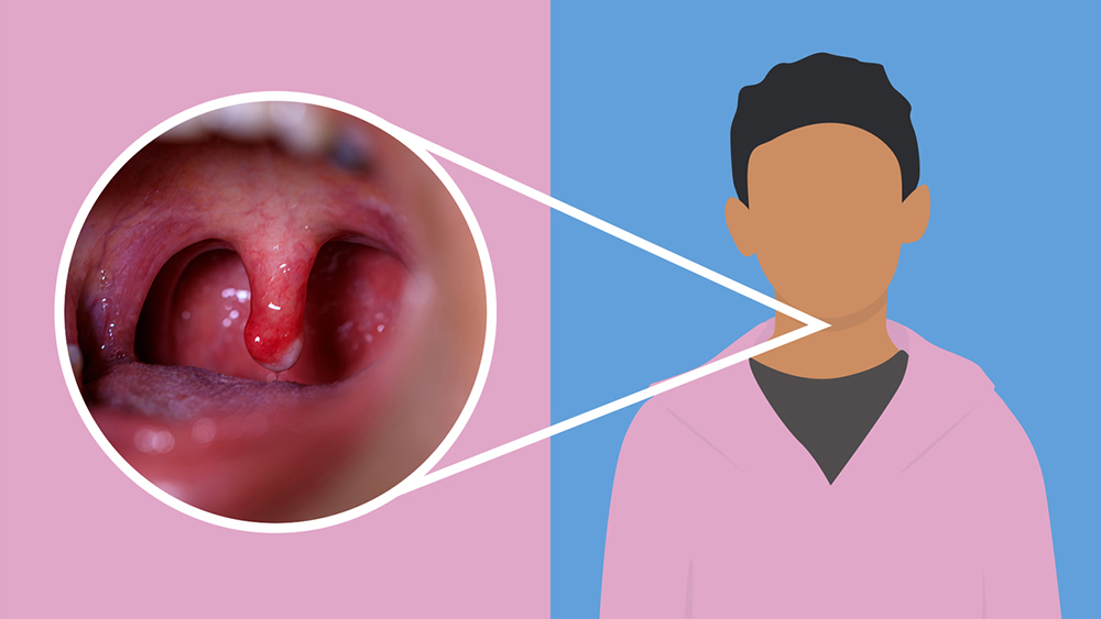 Viêm họng do vi khuẩn có thể khiến họng và amidan sưng đỏ, có mủ trắng