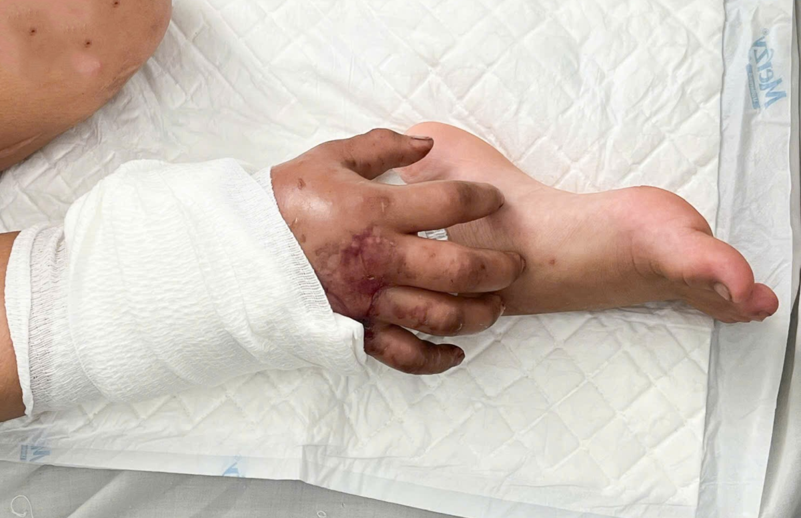 Bàn tay bị đứt lìa được ghép nối tạm vào chân người bệnh để nuôi sống mô trong thời gian chờ nối lại - Ảnh: BVCC