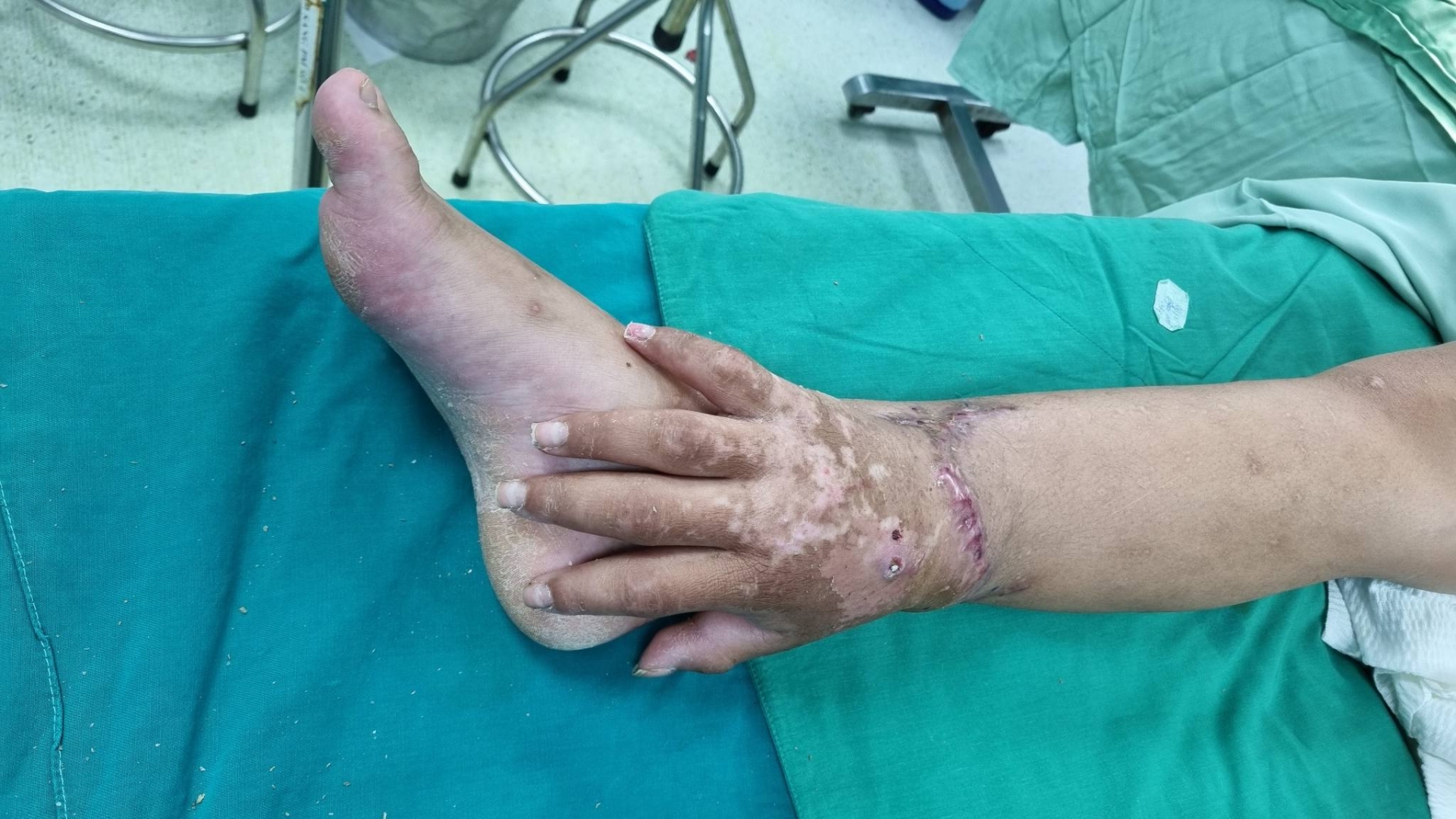 Bàn tay được cấy ghép tạm thời vào cẳng chân - Ảnh: BVCC