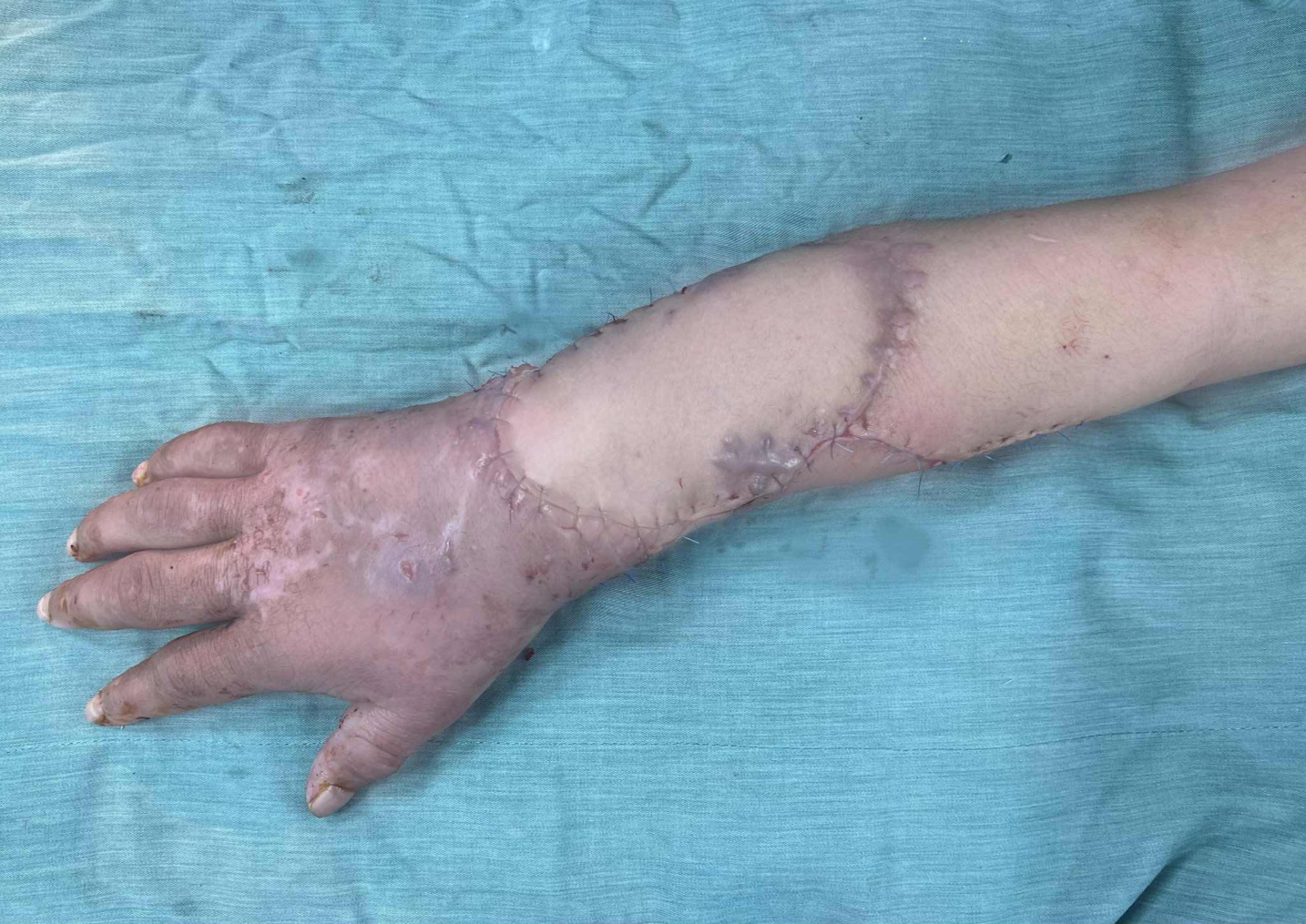 Bàn tay sau khi được nối lại - Ảnh: BVCC