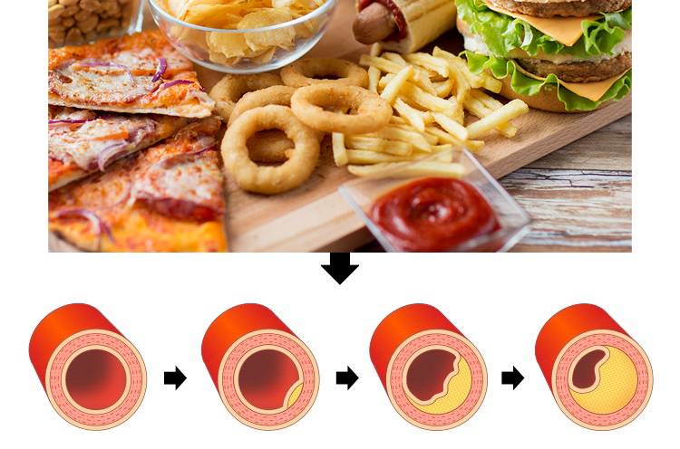 Ăn nhiều chất béo bão hòa có thể làm tăng LDL cholesterol, thúc đẩy tích tụ mảng bám trong mạch máu