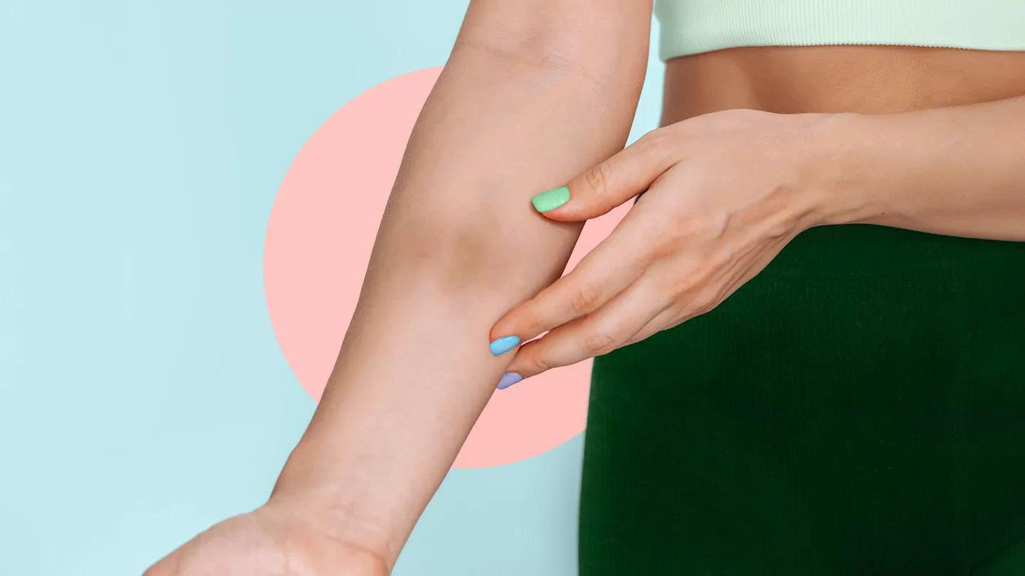 Thiếu hụt vitamin C khiến bạn dễ bầm tím dù chỉ va chạm nhẹ