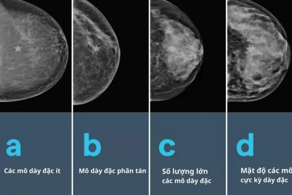 Mật độ mô vú theo từng mức độ - Ảnh: Bệnh viện Đa khoa Phương Đông