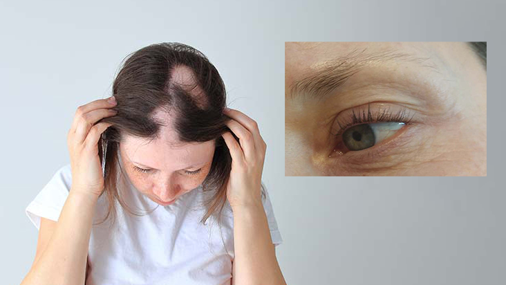 Chứng rụng tóc từng mảng có thể tấn công bất cứ vùng lông tóc nào trên cơ thể