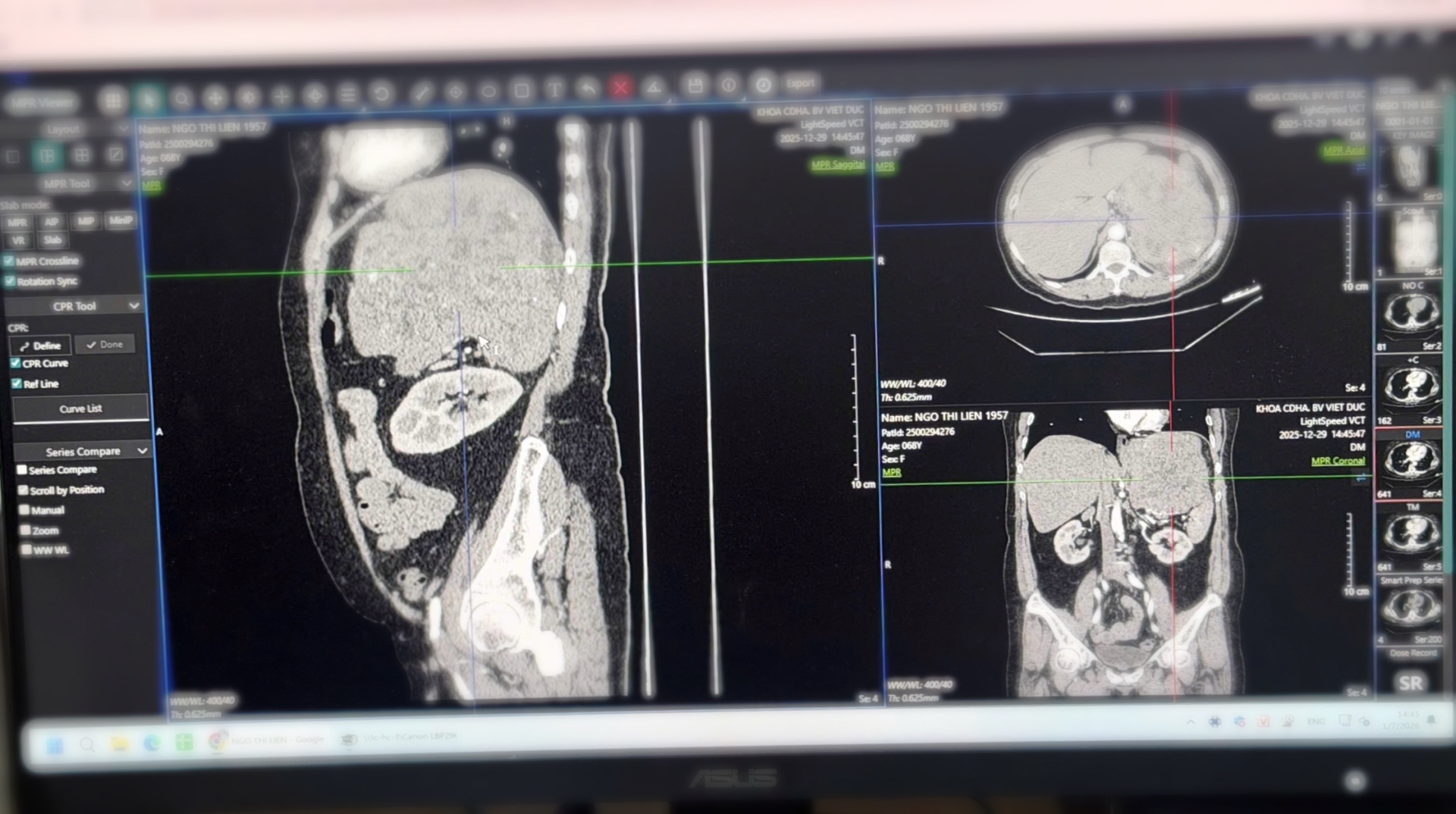 Hình ảnh phim chụp khối u kích thước 20cm của bệnh nhân - Ảnh: BVCC.