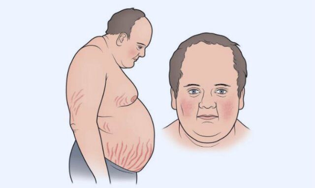 Betamethasone là một glucocorticoid mạnh, lạm dụng trong thời gian dài có thể dẫn đến hội chứng Cushing