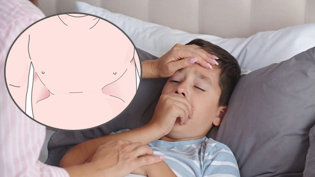 Dấu hiệu thở rút lõm lồng ngực cảnh báo trẻ bị viêm phổi