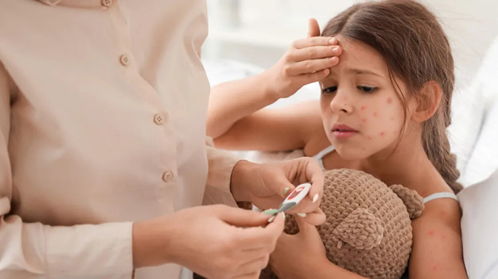 Cha mẹ cần hạ sốt đúng cách cho trẻ thủy đậu