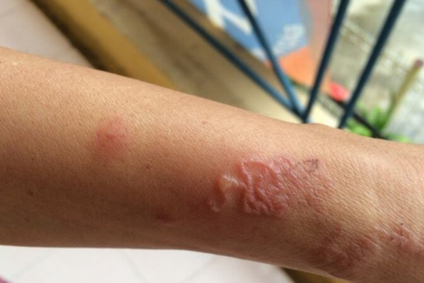 Giun sán ở thú cưng lây sang người và di chuyển dưới da