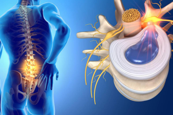 Một số nghiên cứu khác cũng cho thấy, thừa cân còn có nguy cơ gây thoát vị đĩa đệm