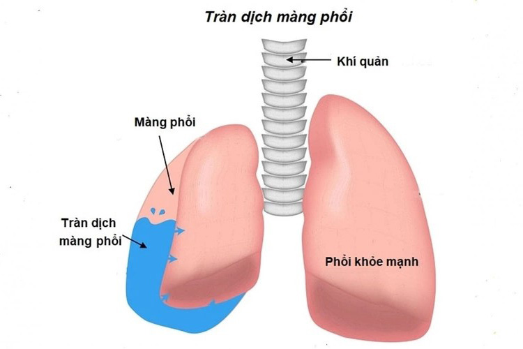 Dịch tích tụ trong khoang màng phổi chèn ép phổi, làm giảm khả năng trao đổi oxy và gây khó thở  