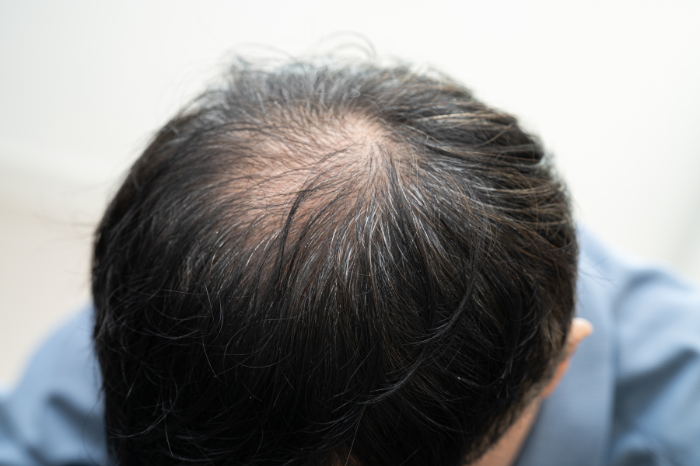 Không ít người lo lắng rằng việc đội mũ thường xuyên có thể khiến tóc yếu đi và rụng nhiều hơn.