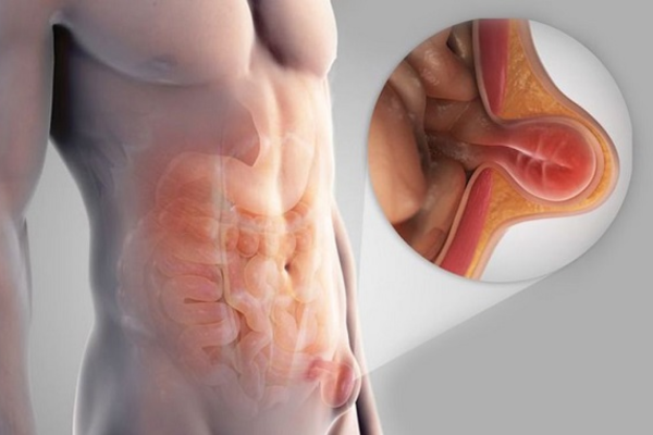 Thoát vị bẹn là tình trạng phổ biến hơn ở nam giới, mang cảm giác khó chịu như đau, tức hoặc nóng rát vùng bẹn.