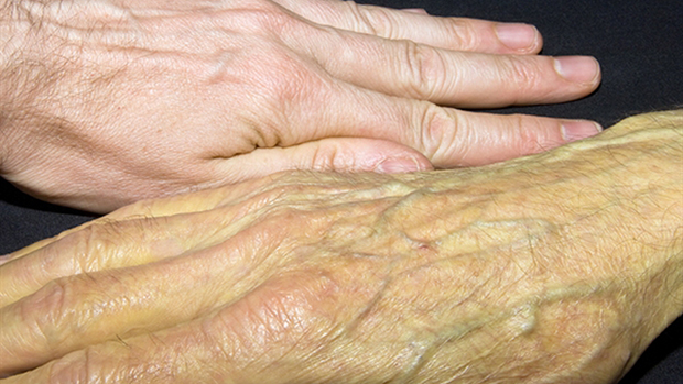 Vàng da, mắt vàng có thể là dấu hiệu u phổi di căn gan