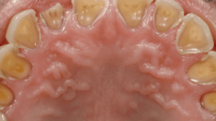 Ngoài là nguyên nhân gây hôi miệng, trào ngược dạ dày - thực quản còn có thể làm mòn men răng.