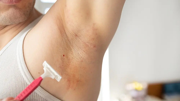 Da vùng nách bị rát, ngứa sau khi cạo lông không đúng cách