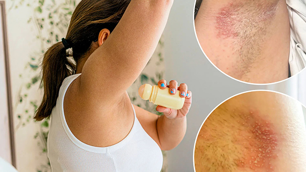 Da dưới cánh tay có thể dị ứng với kim loại như nhôm trong sản phẩm chống mồ hôi