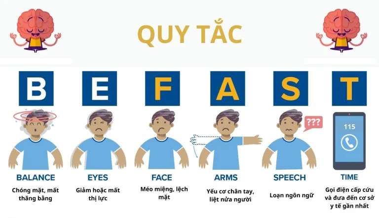 Quy tắc BEFAST giúp nhận biết nhanh dấu hiệu tai biến mạch máu não