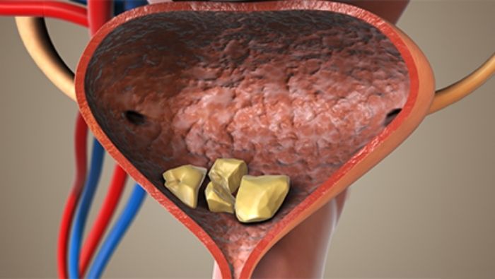 Nước tiểu ứ đọng lâu ngày là nguyên nhân hàng đầu gây nhiễm trùng đường tiết niệu (UTI) và hình thành sỏi bàng quang ở nữ giới