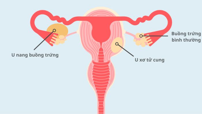 Hình minh họa sự khác biệt vị trí giữa u nang buồng trứng và u xơ tử cung