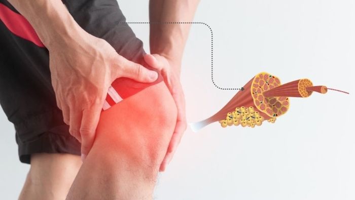 Mỡ thừa tích tụ bất thường bên trong cơ đùi làm tăng nguy cơ viêm khớp gối