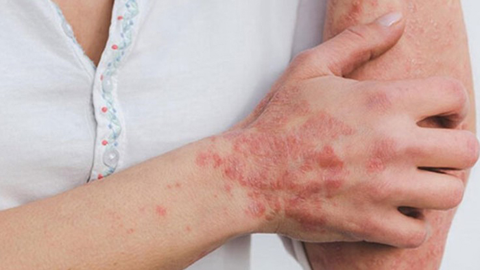 Viêm khớp vảy nến có thể gây tàn tật vĩnh viễn nếu điều trị chậm trễ và không đúng cách