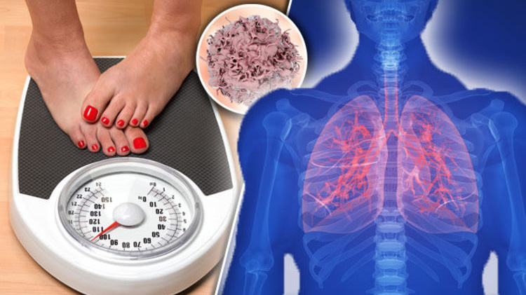Sụt cân không chủ đích đi kèm mệt mỏi kéo dài có thể do ung thư