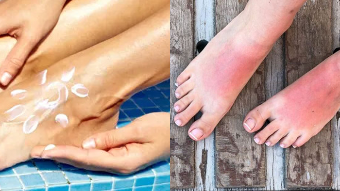 Nhiều người bỏ quên mu bàn chân khi thoa kem chống nắng, khiến da bị cháy nắng, đỏ rát