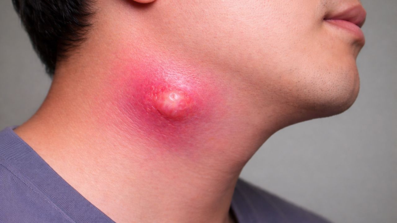 Từ đau họng, viêm amidan, bệnh có thể tiến triển thành áp xe cổ nguy hiểm