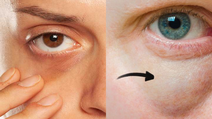 Tiêm filler dưới mắt dễ gây tắc nghẽn hệ bạch huyết, đồng thời không phù hợp với quầng thâm do di truyền