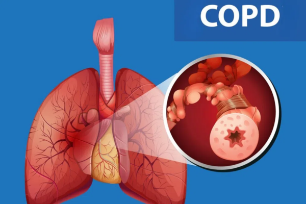Theo Tổ chức Y tế Thế giới (WHO), bệnh phổi tắc nghẽn mạn tính (COPD) là nguyên nhân gây tử vong đứng thứ 3 toàn cầu.