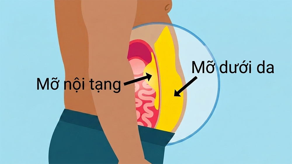 Mỡ nội tạng nằm sâu bên trong là nguyên nhân chính khiến bụng to và khó can thiệp