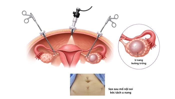 U nang buồng trứng có kích thước lớn trên 5cm thường được chỉ định phẫu thuật để tránh biến chứng