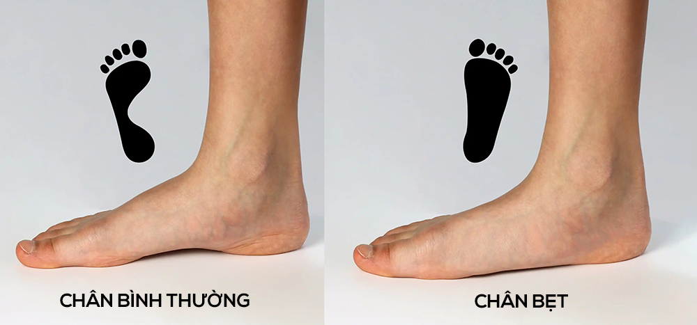 Bàn chân bẹt với gan chân phẳng lì là một dạng dị tật phổ biến trên thế giới