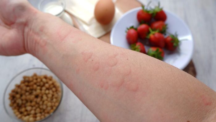 Phụ huynh nên loại bỏ các thực phẩm gây kích ứng khiến bé nổi mề đay