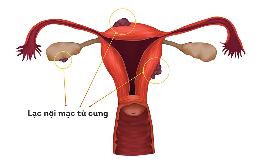 Lạc nội mạc tử cung là thủ phạm giấu mặt gây rong kinh và đau bụng dữ dội