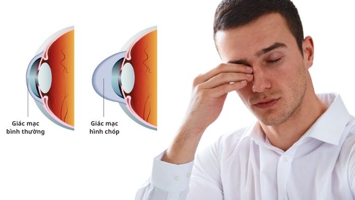 Giác mạc hình chóp khiến thị lực mờ trầm trọng